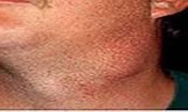 گره های تیروئیدی و سرطان گره های تیروئیدی و سرطان